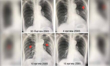 “หมอมนูญ” ระบุ กรณีผู้ป่วยสูงอายุติดเชื้อ “ไวรัส RSV” พบมีอาการหนักกว่าโควิด-19