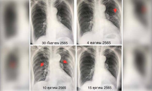 “หมอมนูญ” ระบุ กรณีผู้ป่วยสูงอายุติดเชื้อ “ไวรัส RSV” พบมีอาการหนักกว่าโควิด-19